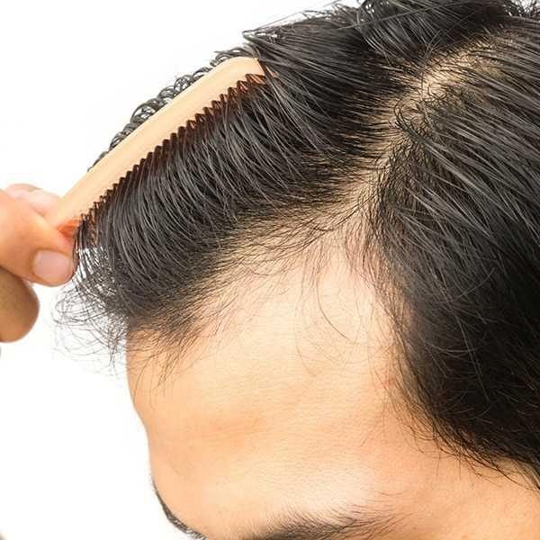 FUE Hair Transplant