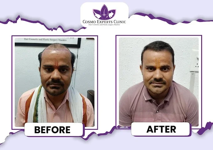 3500 Grafts FUE hair transplant before after result