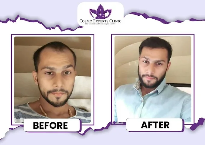 4000 Grafts FUE hair transplant before after result