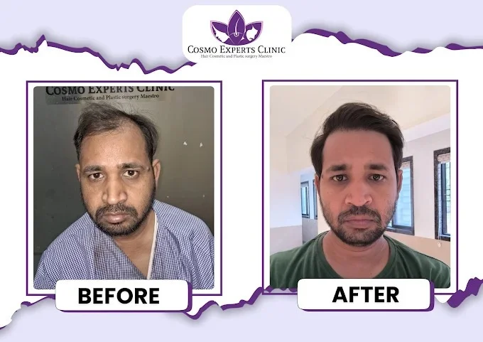 2800 Grafts DHI hair transplant before after result